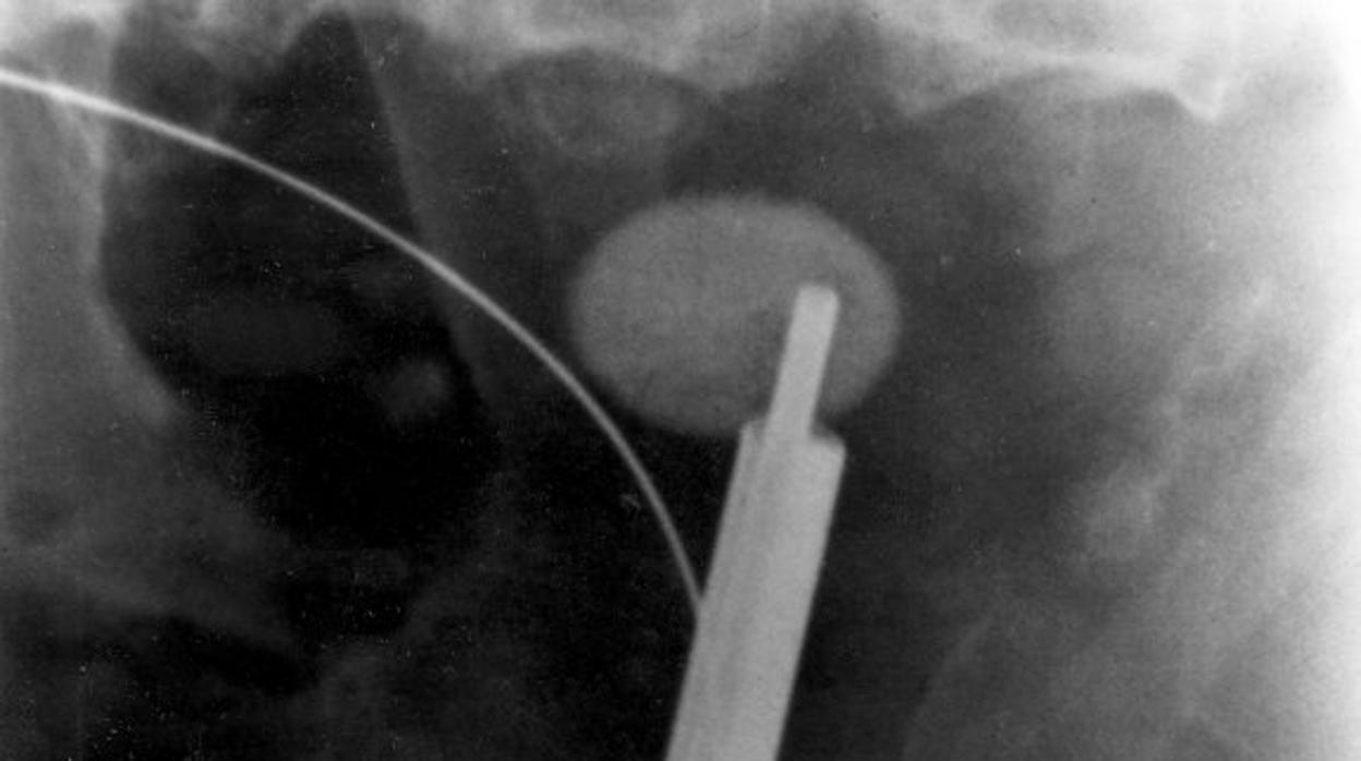 Imagen tomada mediante rayos X de un cálculo renal causante de cólicos nefríticos
