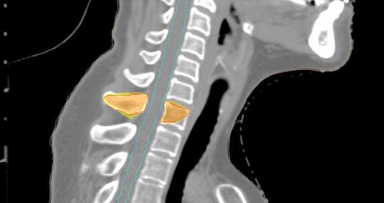 Imagen de una lesión tumoral en una vértebra