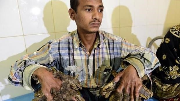 El extraño caso del «hombre árbol» de Bangladés