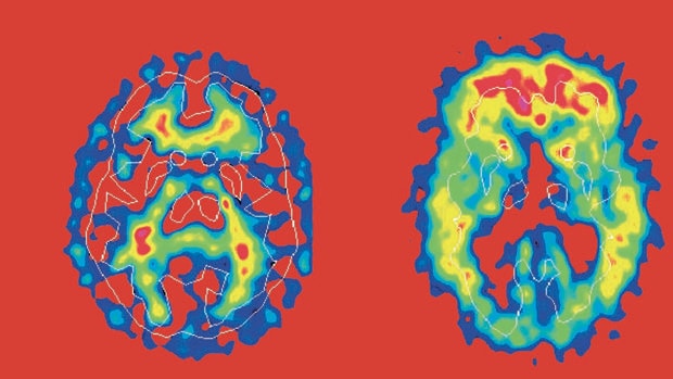Imagen de un cerebro dañado por el Mal de Alzheimer