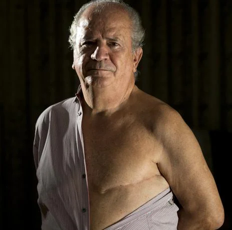 Ernesto Herrero, tenía 61 años cuando un día notó en la ducha cómo su pezón izquierdo se había retraído hacia dentro. E diagnóstico no se hizo esperar: cáncer de mama