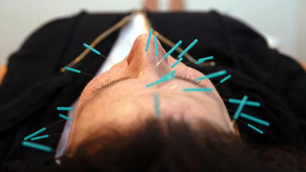 Un hombre se somete a una sesión de acupuntura