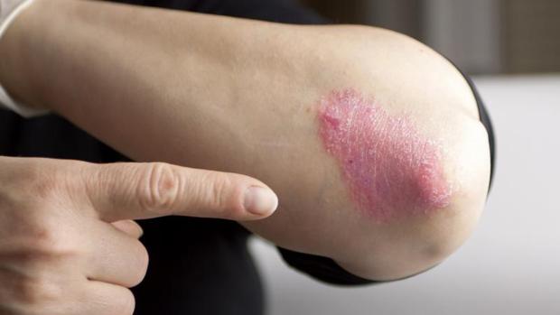 Dermatólogos avisan de que el 30% de casos de psoriasis se dan antes de cumplir los 20 años