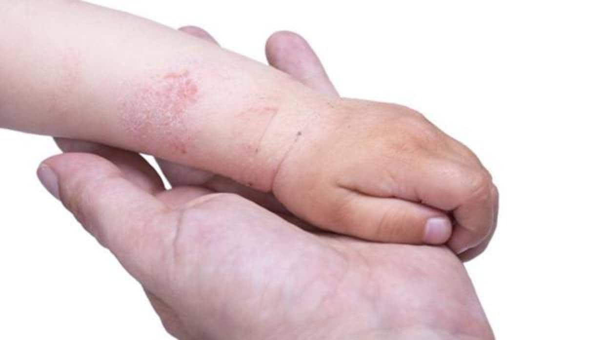El 15% de la población en España sufre dermatitis atópica severa