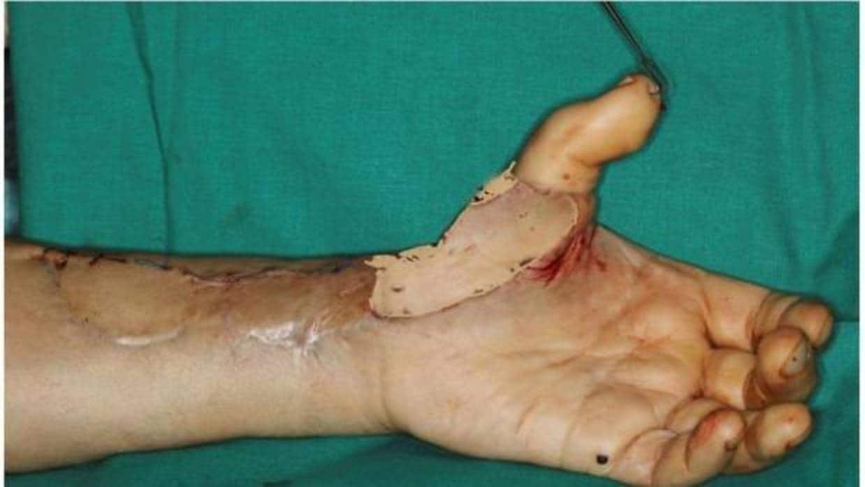 Imagen de la mano después del trasplante