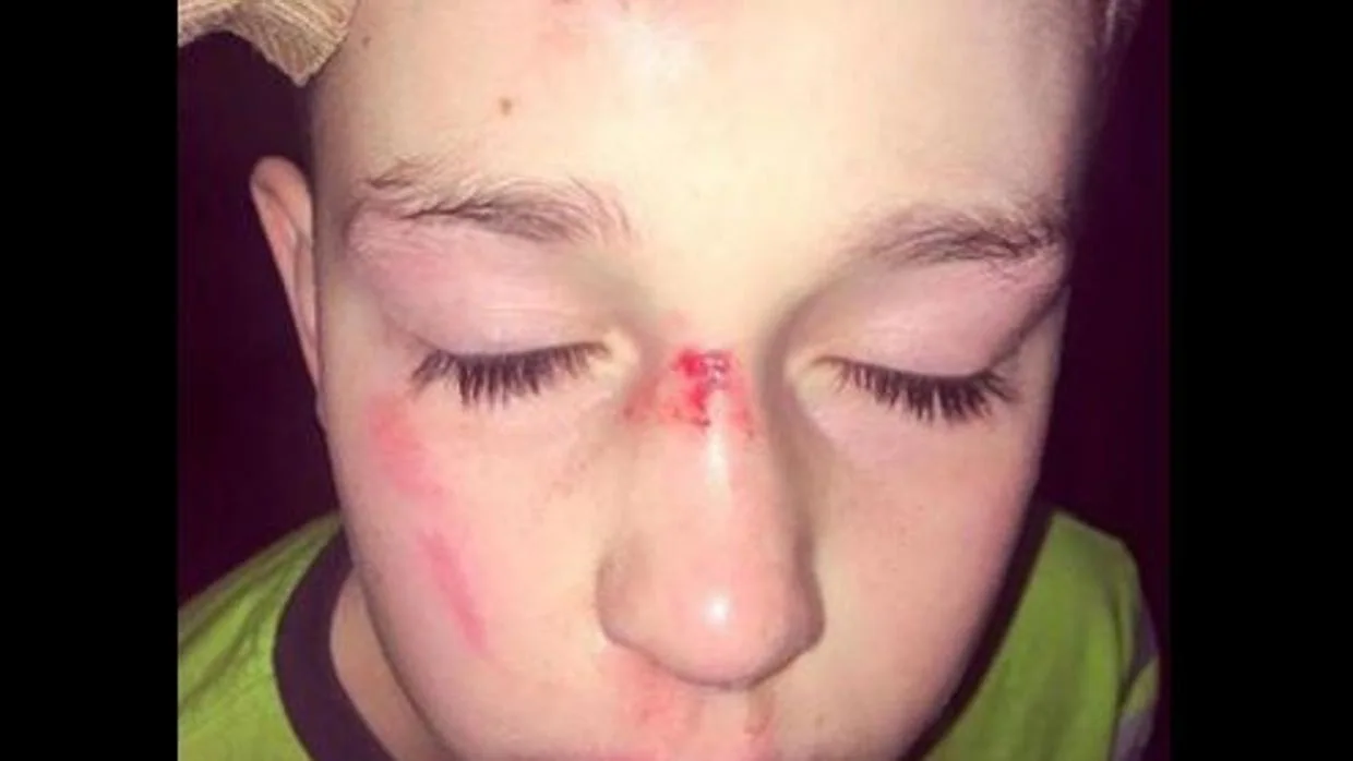 Así quedó la cara de un niño de 11 años autista tras ser acosado en el colegio por sus compañeros