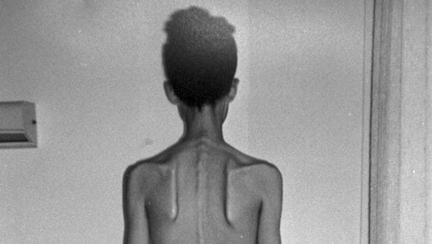 «Si la anorexia no se controla a tiempo, puede acabar en suicidio»