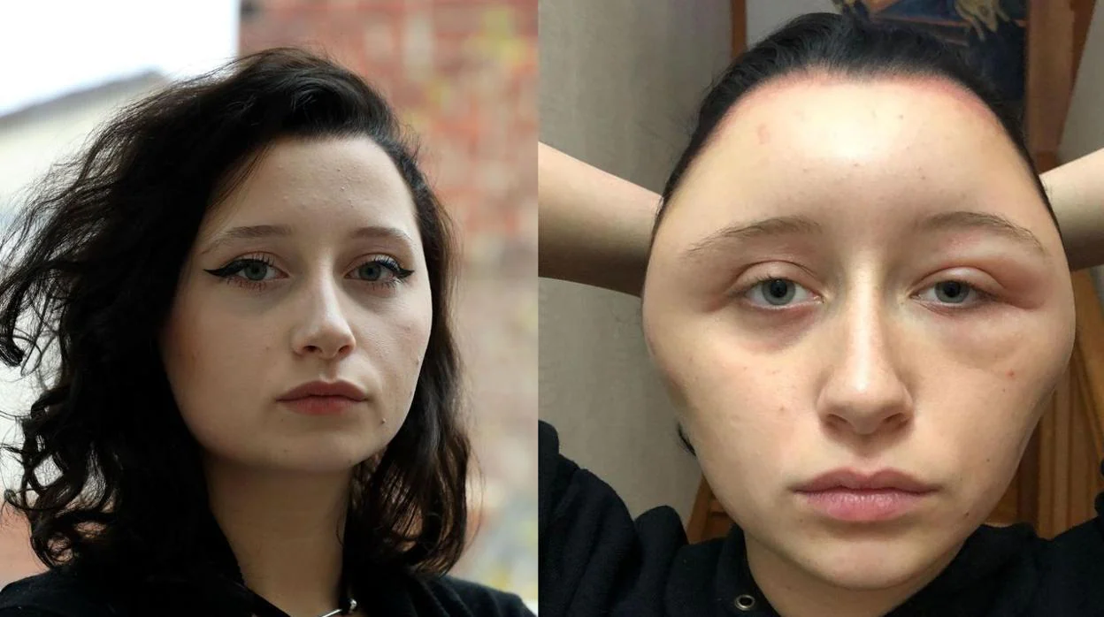 Una joven francesa acaba con la cara deformada y al borde de la muerte por teñirse el pelo