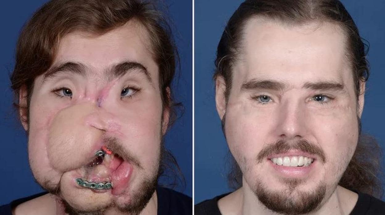 Asombrosa reconstrucción: el trasplante de cara que ha dado una segunda oportunidad a un joven 26 años