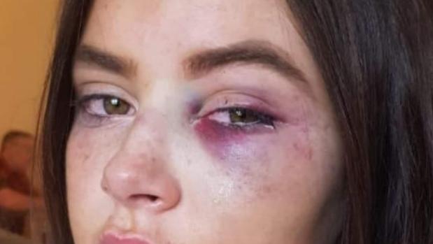 Una adolescente víctima de bullying a la que dieron una brutal paliza se venga convirtiéndose en modelo