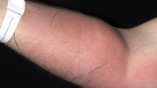 El sorprendente caso del hombre que se inyecta semen en el brazo para tratar su dolor de espalda