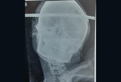 Un joven sobrevive después de que una barra de hierro le atravesara el cráneo