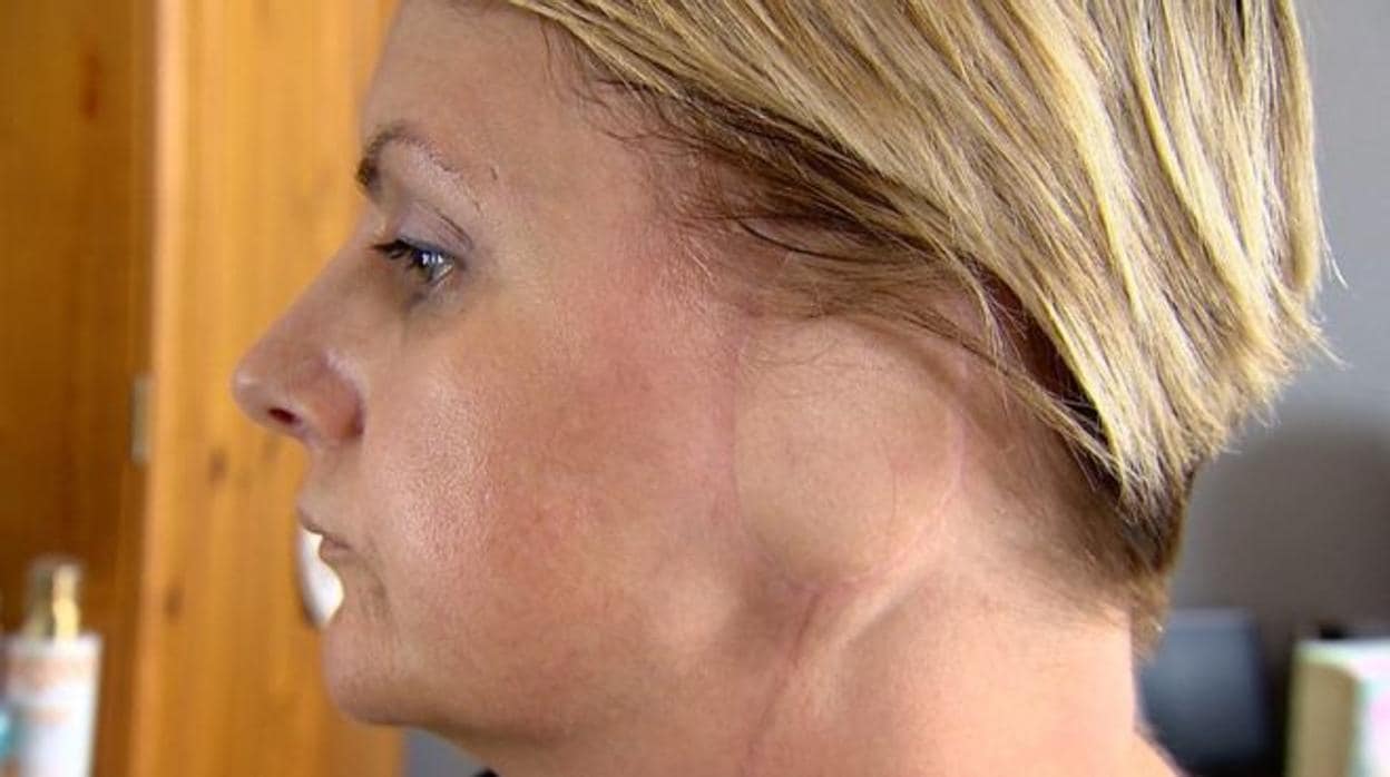Una mujer desarrolla cáncer de piel y pierde la oreja izquierda por su adicción a las cabinas de bronceado