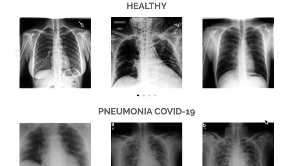 Investigadores españoles desarrollan una herramienta que predice la evolución de pacientes con coronavirus