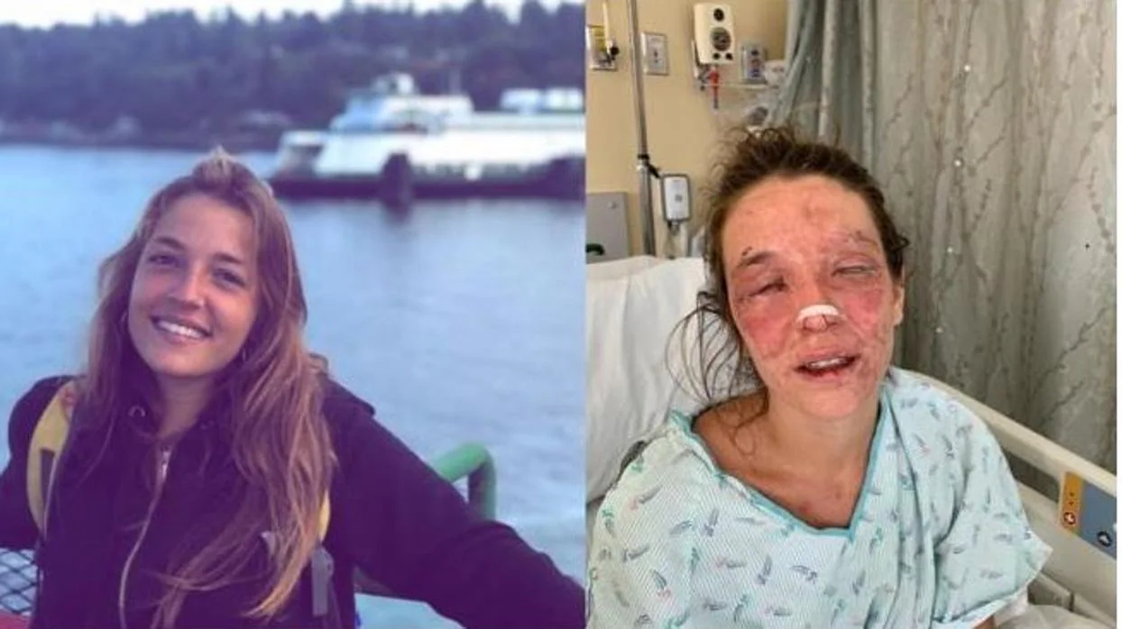 La joven, antes y después del accidente