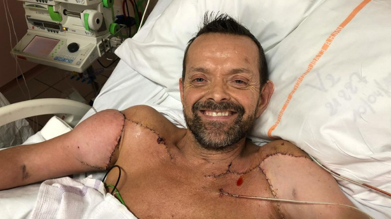Félix, el primer trasplantado de brazos y hombros del mundo vuelve a abrazar a su familia 20 años después