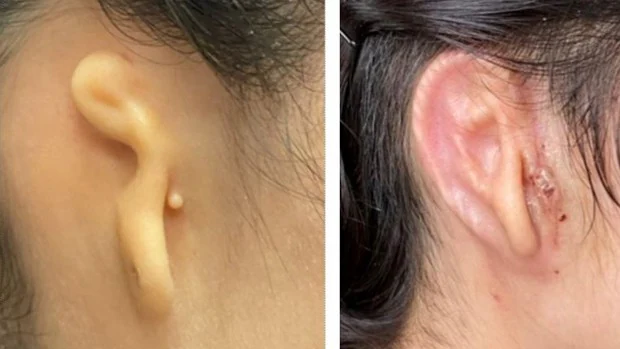 Trasplantan una oreja impresa 3-D con las células del propio paciente