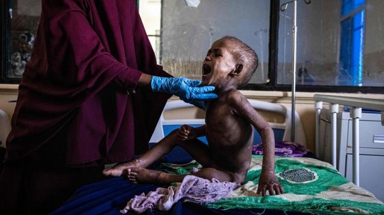 Ali Abdullahi Mohamed, un niño de 27 meses gravemente desnutrido, este 1 de junio en un hospital de Somalia