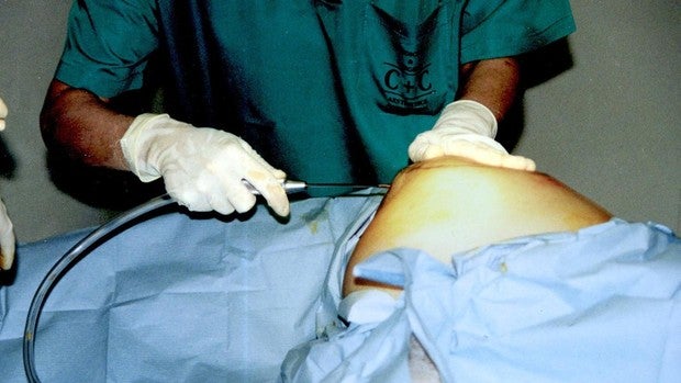 400.000 operaciones al año y el pecho como principal protagonista: las cifras de la cirugía estética en España