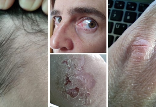 Recopilación de secuelas: zonas sin cabello en el cuero cabelludo, heridas en las manos y tobillos, problemas de visión y en los ojos